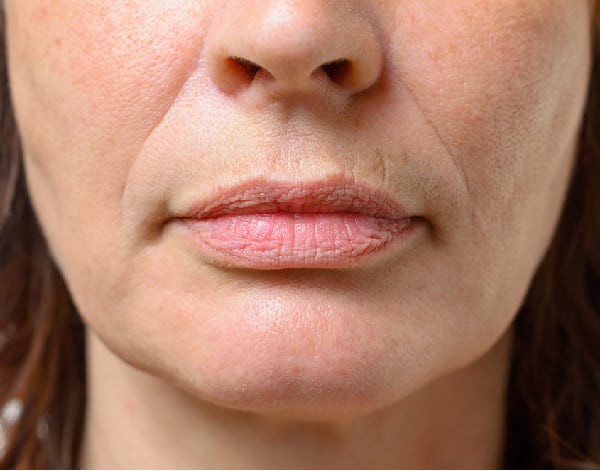 a woman`s perioral area before treatment